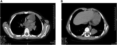 Case report: Uniportal video-assisted thoracoscopic sleeve lobectomy in a 6-year-old patient with inflammatory myofibroblastic tumor (IMT)